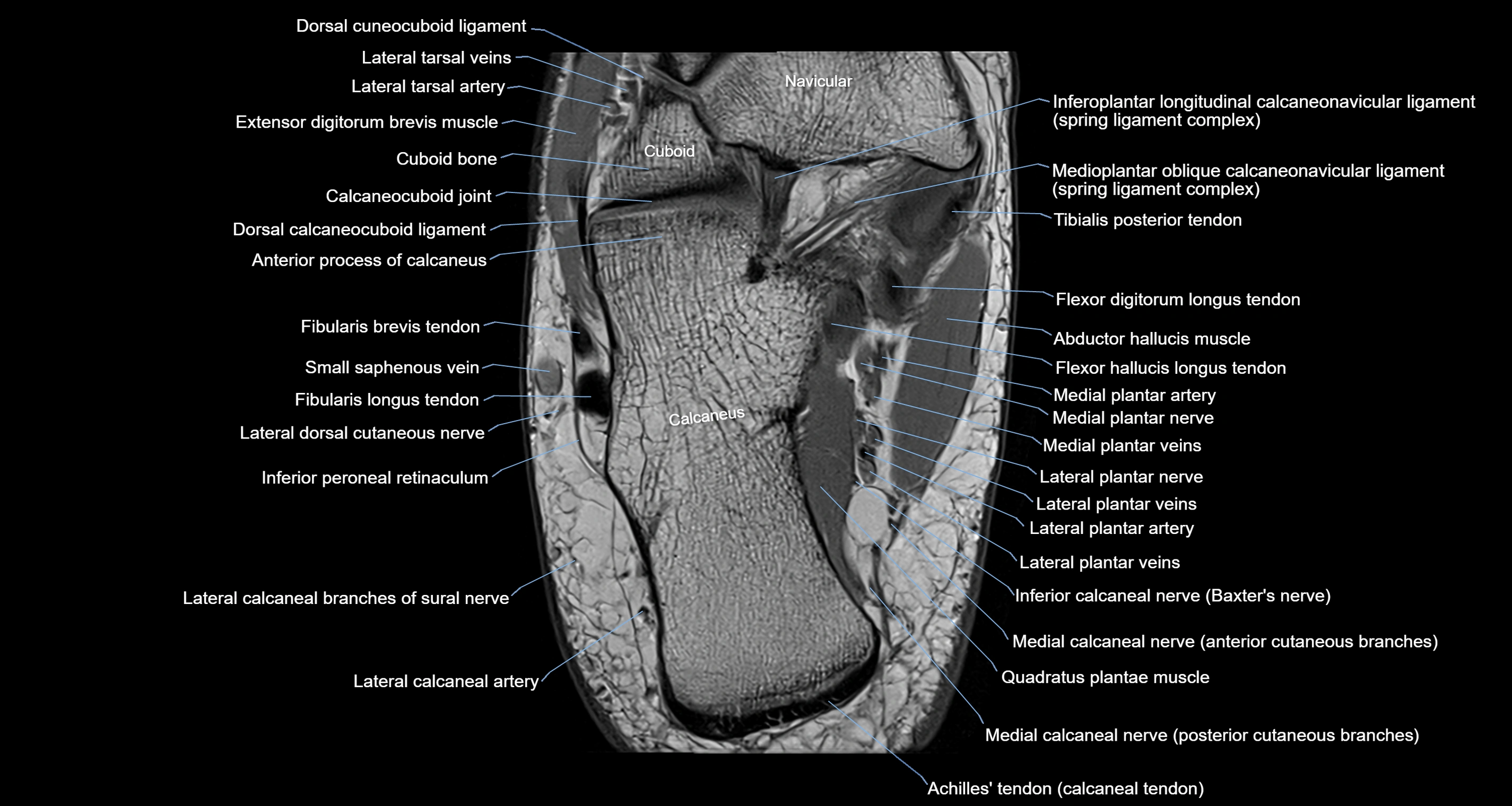 Ankle axial anatomy 3T MRI images -img-10001-00029.webp